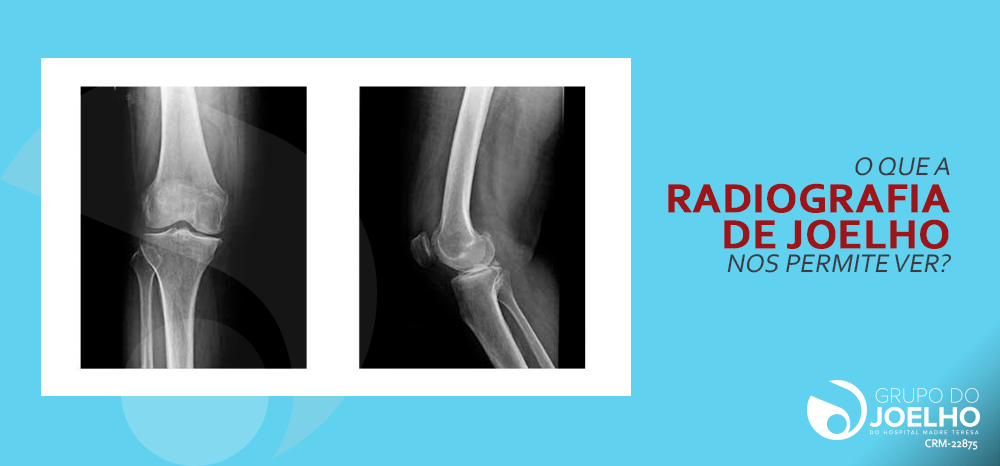 O que a radiografia de joelho nos permite ver?