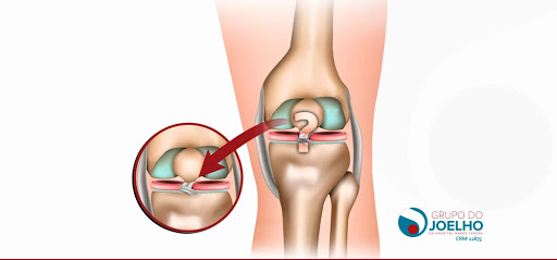 Lesão do ligamento cruzado anterior: você já ouviu falar?