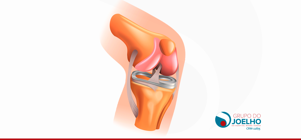 Entenda as lesões no ligamento cruzado posterior