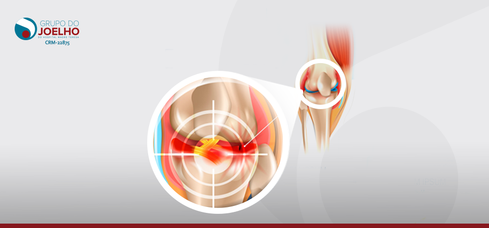 O que é menisco lateral discoide?