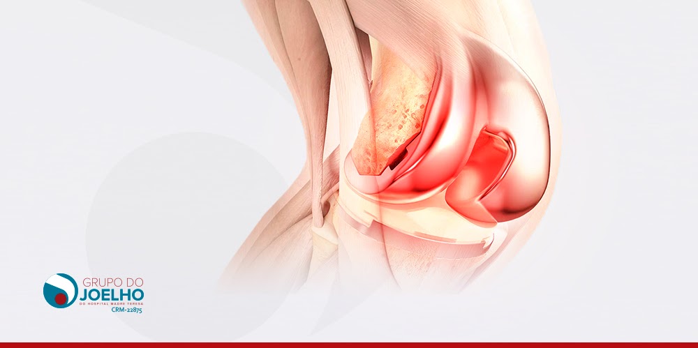 Passo a passo da artroplastia do joelho?